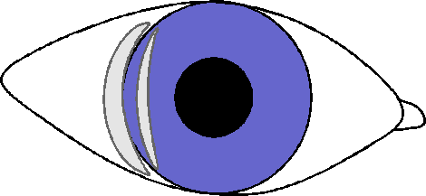 глаукома 1
